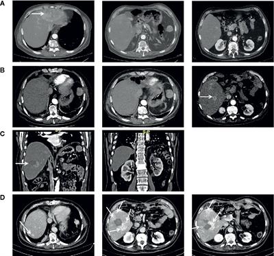 Case Report: BAP1 Mutation and RAD21 Amplification as Predictive Biomarkers to PARP Inhibitor in Metastatic Intrahepatic Cholangiocarcinoma